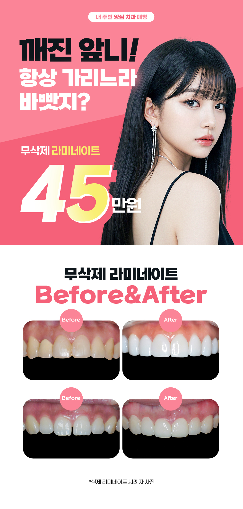 대전라미네이트 대전치과 이벤트